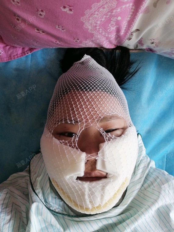 通过新氧消费方案查看面部吸脂手术轻度疼痛瘦脸机构查看洛阳谢景良