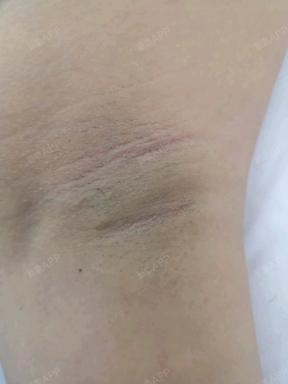 已经短短续续做了五六次了,基本上没有太大感觉,每次