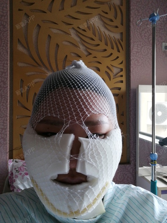 通过新氧消费方案查看面部吸脂手术轻度疼痛瘦脸机构查看洛阳谢景良