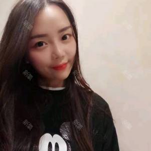 太阳穴自体脂肪填充全脸自体脂肪填充法令纹自体脂肪垫下巴自体脂肪