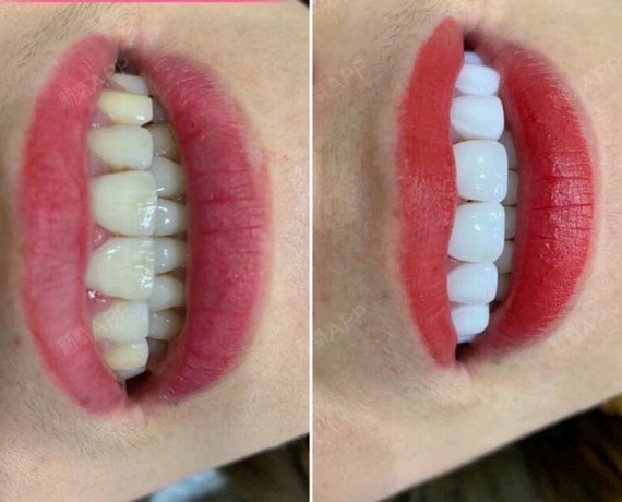 重庆瓷贴面好不好_效果图_黑风你老薛瓷贴面术后第0天_新氧美容整形