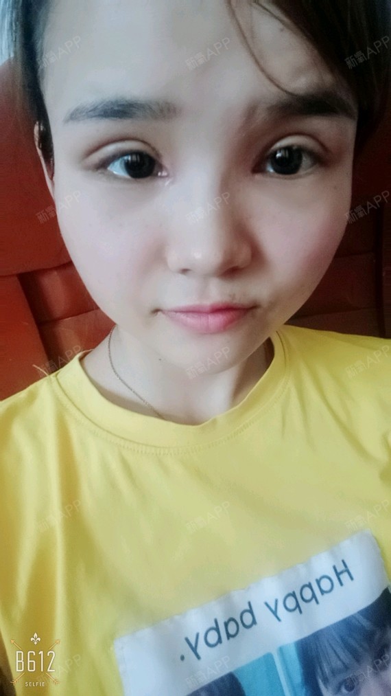 切开双眼皮