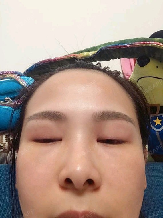 这次主要拍了几张闭眼的照片,给你们看一下双眼皮做的_圈子-新氧美容