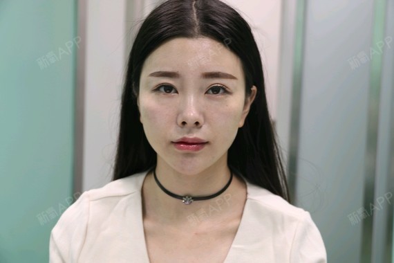 玻尿酸填充面颊