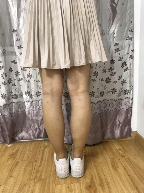 【 吸脂瘦小腿 】