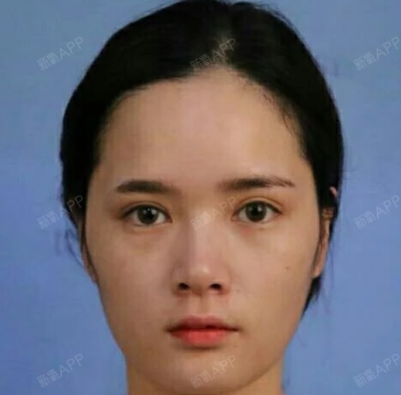 鼻子一直是我的心病,总觉得自己鼻头大,整个鼻形短,_圈子-新氧美容