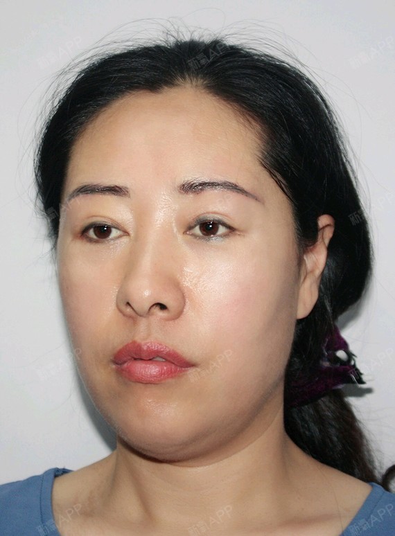 上海切眉术好不好_效果图_馥董哈佛切眉术术后第7天_新氧美容整形