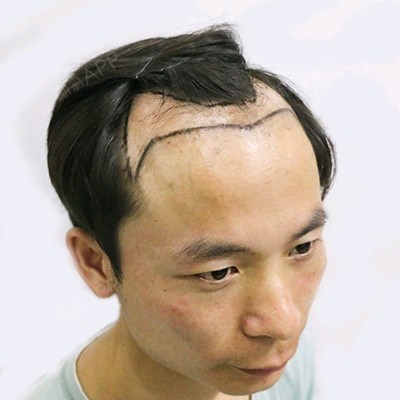 【仁爱植发种植发际线】脱发使人头秃,之前我还不相信_圈子-新氧美容