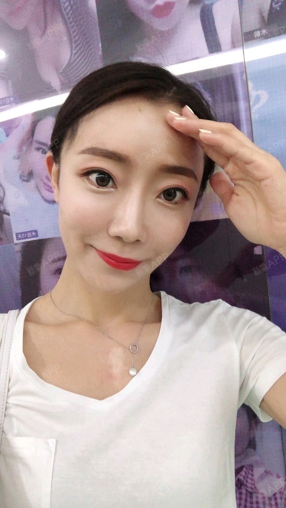 自体脂肪填充卧蚕