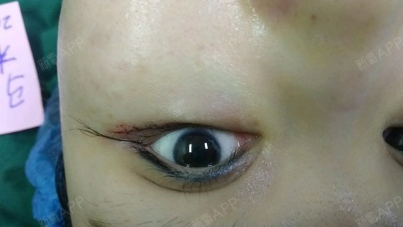 在网上观察就很久啦,最后决定去元素家做的下至和外眼_圈子-新氧美容