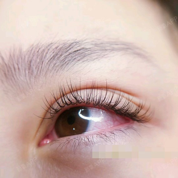 植睫毛不痛的,虽然只是植睫毛,医生也特别认真负责,_圈子-新氧美容