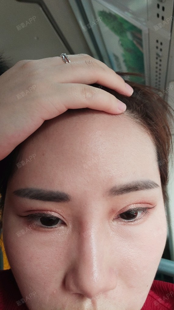 术前才对刚结束术后第一天,不会红肿,高兴._圈子-新氧美容整形