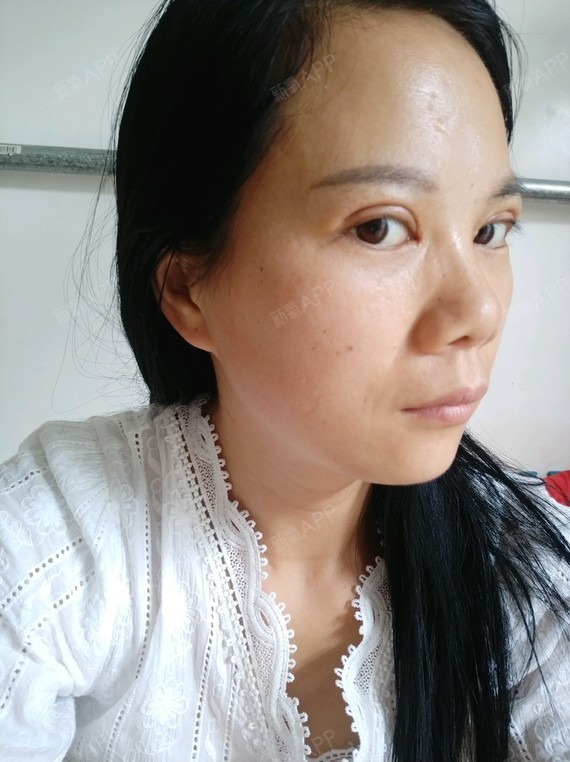 今天拆线第一天,还是有点肿,说一个月以后就会慢慢恢复了,敬请