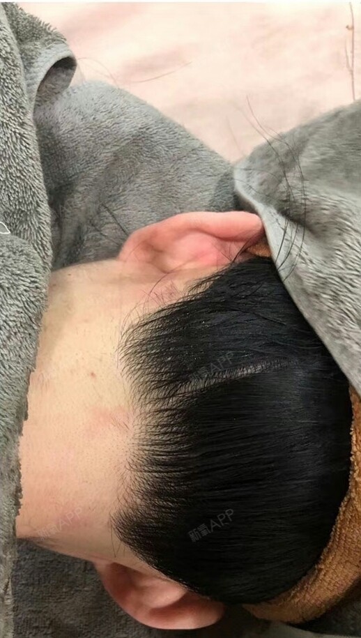 半永久纹发际线