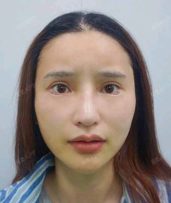 【上海盈美下睑下至术】爱美是每个女生的天性,我之前_圈子-新氧美容