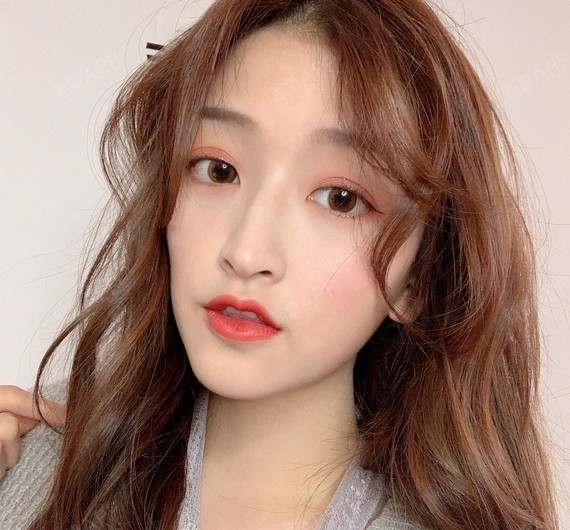 昆明玻尿酸垫下巴好不好_效果图_小姿态嗯玻尿酸垫下巴术后第5天_新氧