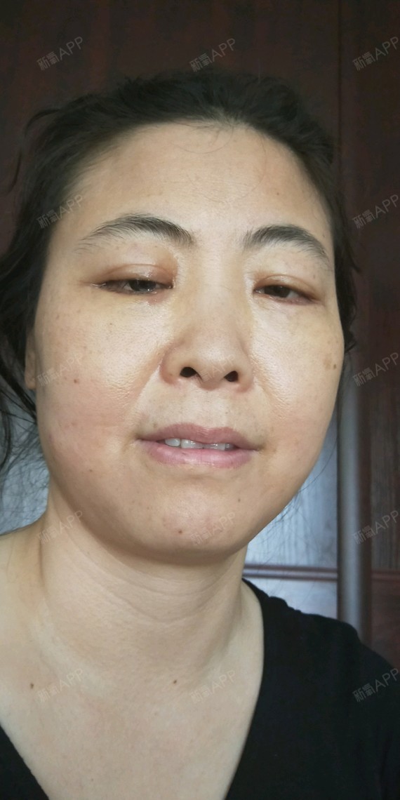 这是眼袋手术的第九天,第七天的时候拆了线,拆线过程_圈子-新氧美容