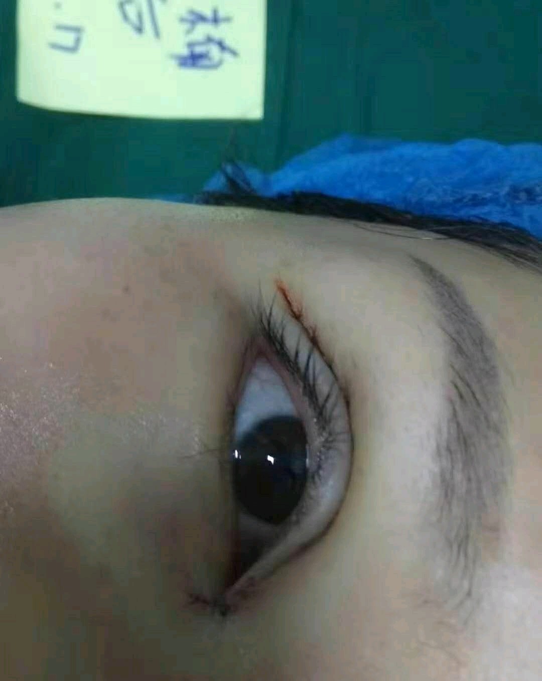 郑州元素美学整形眼部综合怎么样_恢复过程_效果如何_满天星星的整形