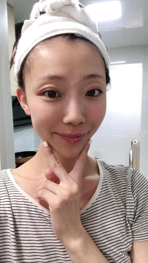 自体脂肪填充卧蚕