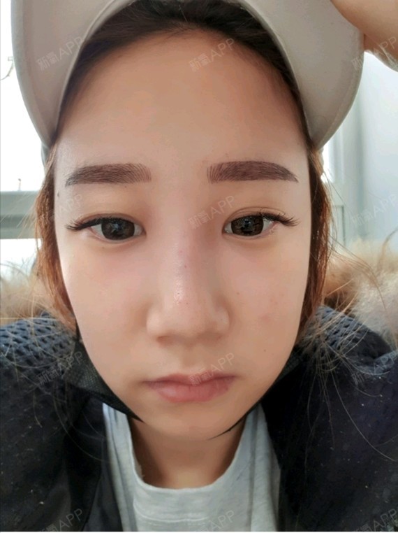 我的脸整个很长 眼睛也很长 两眼间距又宽 显得我很_圈子-新氧美容