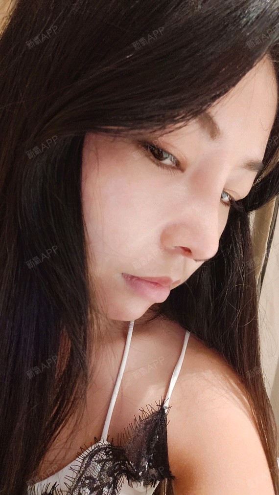 膨体隆鼻好不好_效果图_半肋骨鼻部多项膨体隆鼻术后第20天_新氧美容