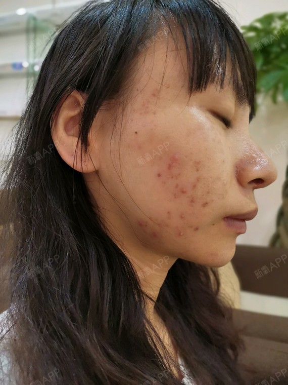 伊肤泉微针