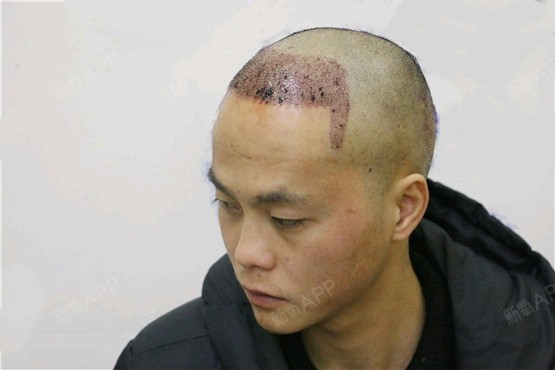 植发最真实感受视频(植发过程视频最新的视频)