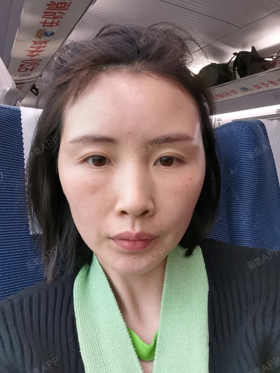 变成了一个脸很宽的胖子. 颧骨非常的凸出._圈子-新氧美容整形