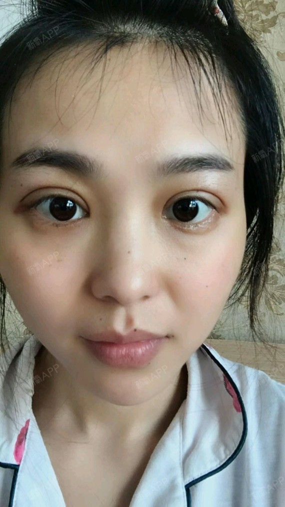 埋线双眼皮好不好_效果图_清风xx埋线双眼皮术后第1天_新氧美容整形