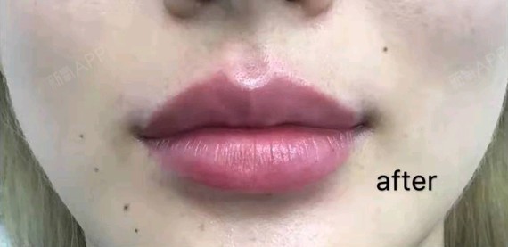 玻尿酸丰唇珠