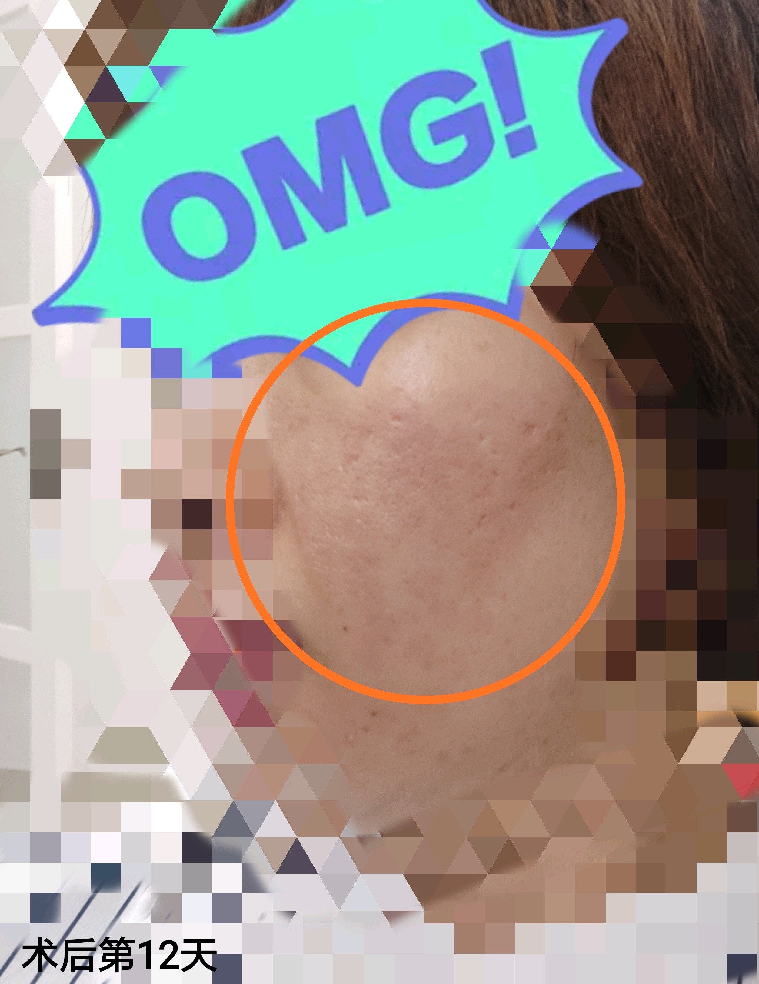 点阵激光怎么样_恢复过程_效果如何_氧气0wo