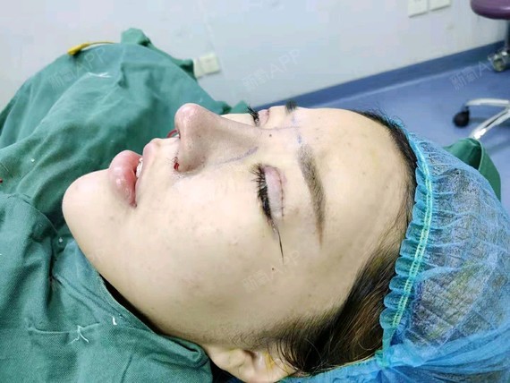 考虑了好久与元素的咨询医生也有联系,之前我的朋_圈子-新氧美容整形