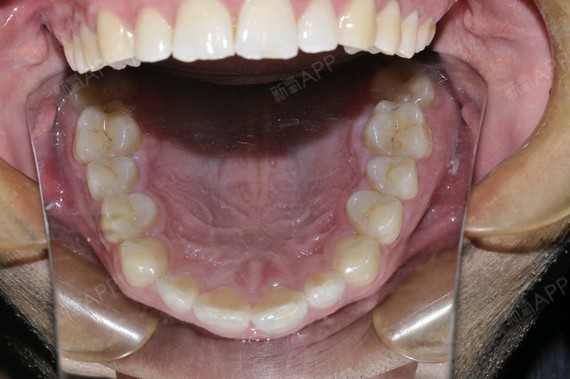 我的下排牙齿又凌乱又拥挤以前糙愣是没觉得有什么这一两年不知怎么就