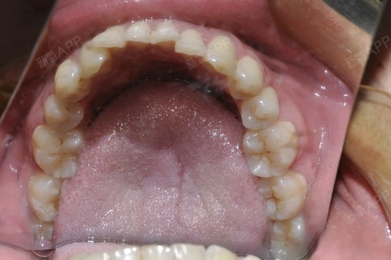 我的下排牙齿又凌乱又拥挤以前糙愣是没觉得有什么这一两年不知怎么就