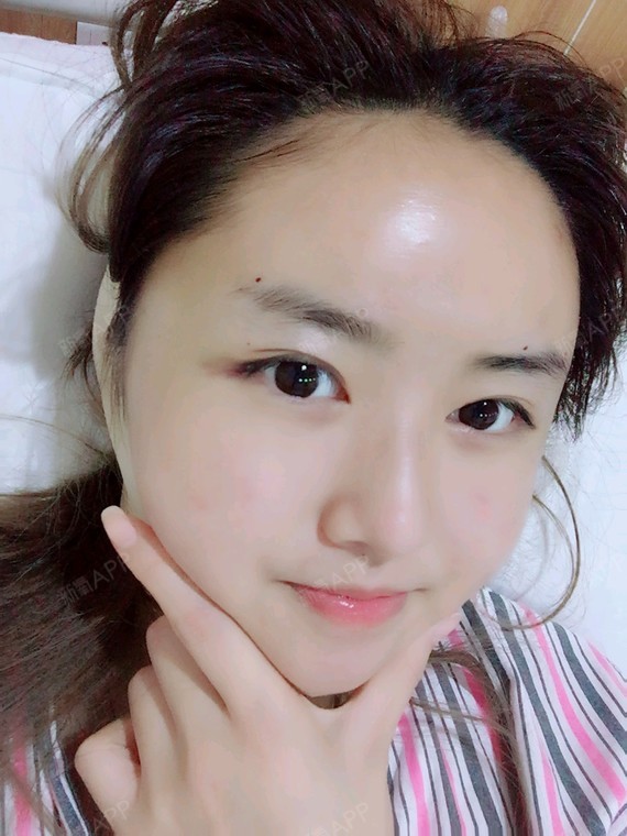 自体脂肪填充卧蚕