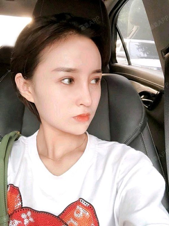肋软骨隆鼻