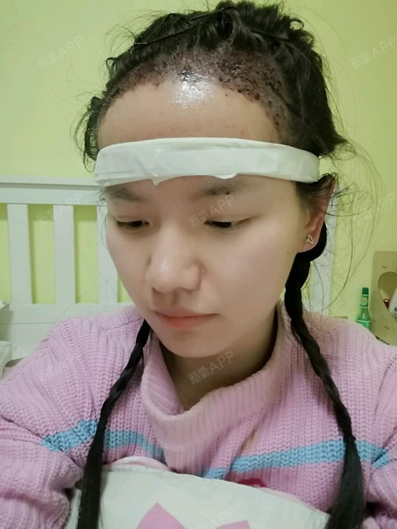 貌美如花的我也开始脱发了,于是我便在新氧上看看有没心肝头扎扎图片