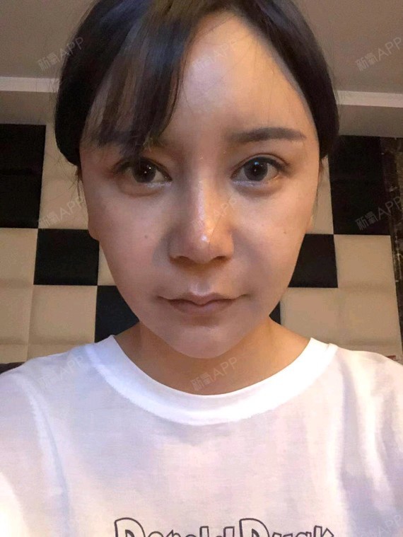 人中缩短术好不好_效果图_思寒人中缩短术术后第0天_新氧美容整形