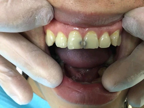 门牙被蚜虫蛀了,一直都有黑色的印子在这,感觉牙齿的_圈子-新氧美容