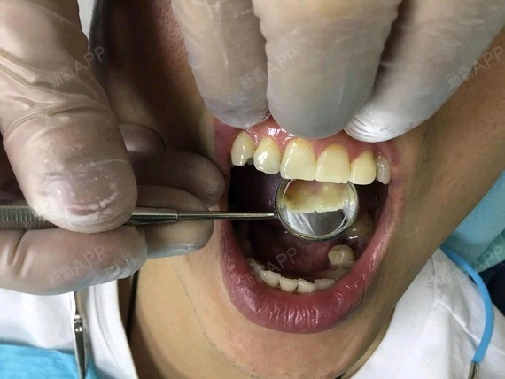 门牙被蚜虫蛀了,一直都有黑色的印子在这,感觉牙齿的_圈子-新氧美容