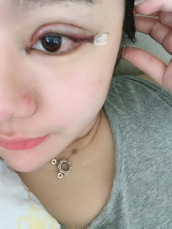 眼修复切开双眼皮术后第一天肿到怀疑人生啊