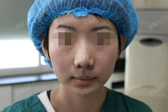 【鼻翼缩小&鼻翼上提】