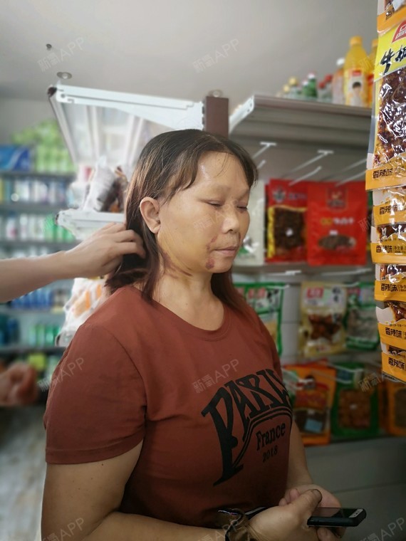 成都拉皮手术提升好不好_效果图_何志蓉拉皮手术提升术后第10天_新氧