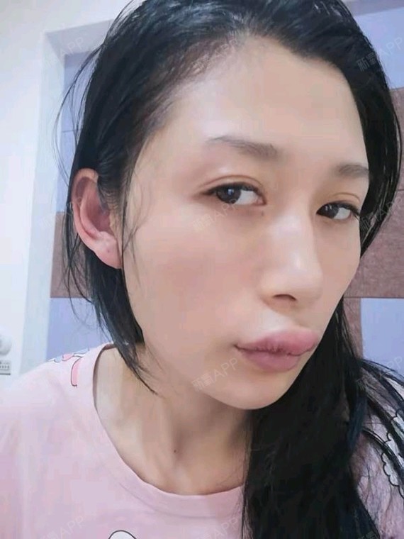 术后第一天,一直觉得自己的嘴巴不好看,尤其是上唇,_圈子-新氧美容