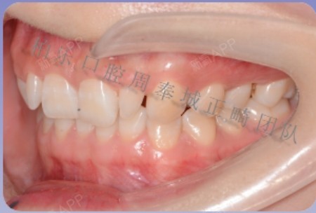 主诉深覆合两颗侧切牙过小