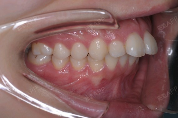 的蛋糕说通过矫正常规拔正畸牙,并进行扩展牙弓宽度,让牙弓形态更好看