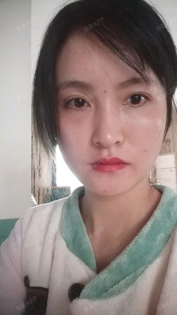 已经20天了,时间过的还挺快的,最难熬的前5天已经_圈子-新氧美容整形