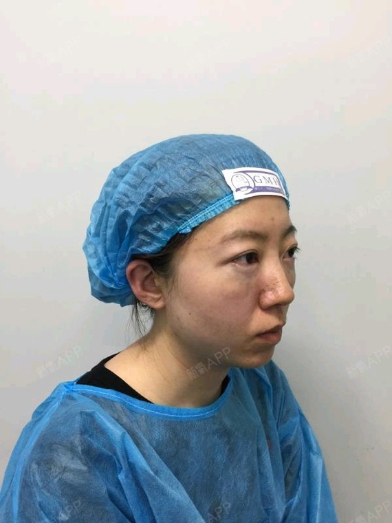北京眶隔脂肪释放好不好_效果图_怪咖软妹lalala眶隔脂肪释放术后第3