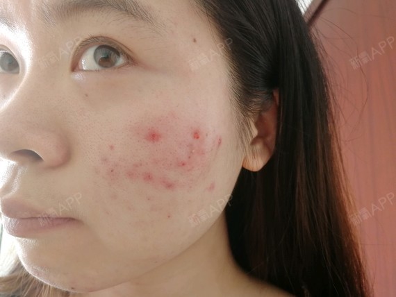 我的祛痘路终于开始了——(1)针清加红蓝光