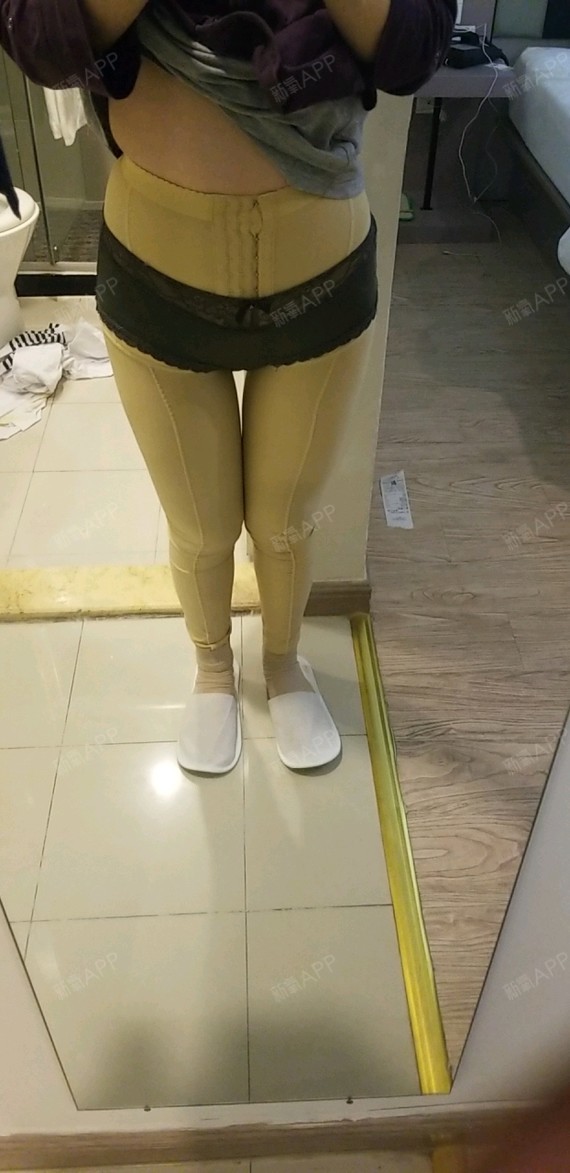 上海吸脂瘦大腿好不好_效果图_氧气47n6o吸脂瘦大腿术后第1天_新氧